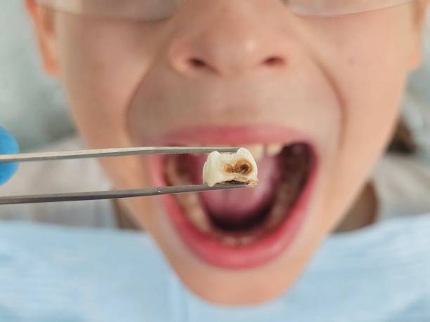 Best Emergency Tooth Extraction in Thermal, CA