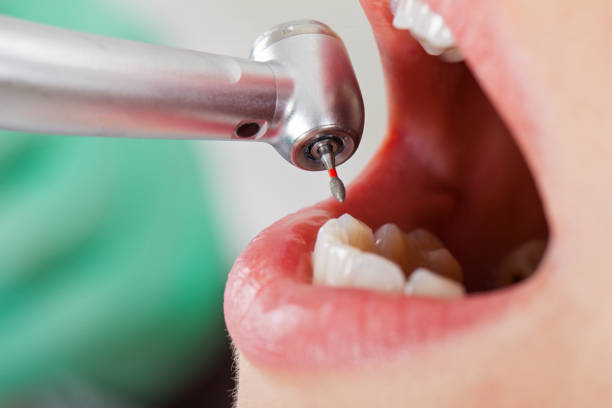 Best Emergency Dental Care for Broken or Chipped Teeth in Thermal, CA